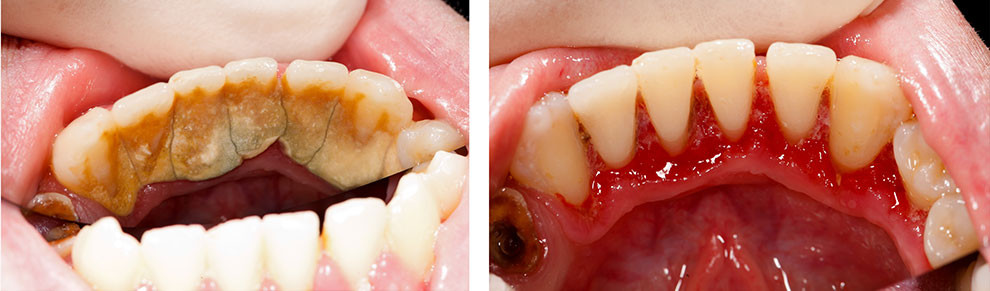 gum infection after teeth cleaning